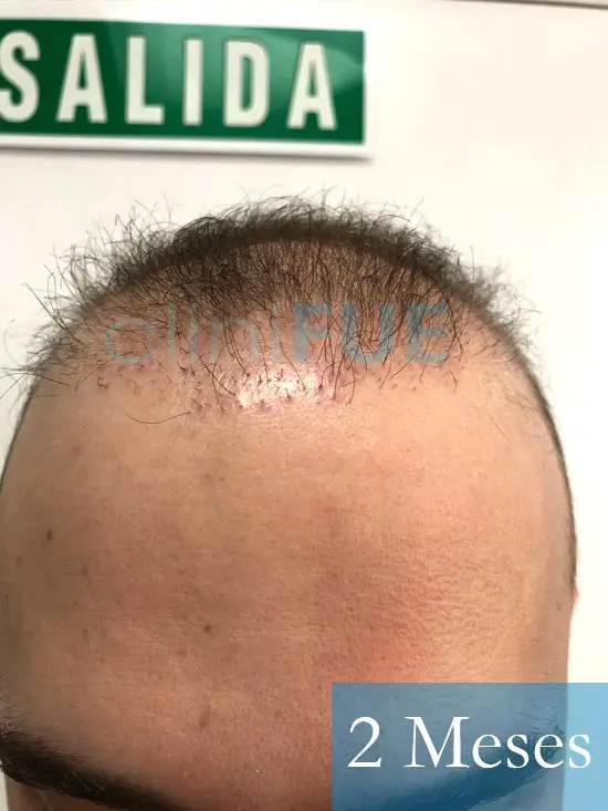 Martin 28 años Murcia trasplante capilar turquia 2 meses 