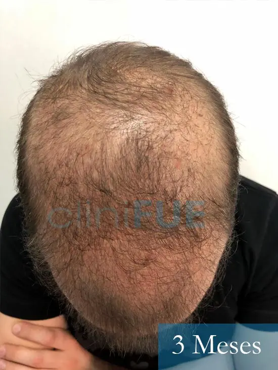 Martin 28 años Murcia trasplante capilar turquia 3 meses 2