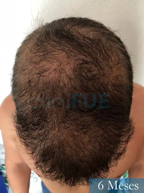 Martin 28 años Murcia trasplante capilar turquia 6 meses 2