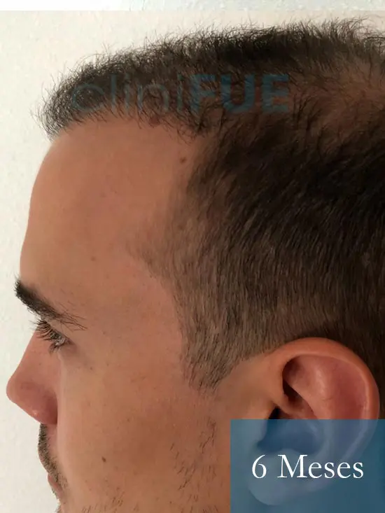Martin 28 años Murcia trasplante capilar turquia 6 meses 4