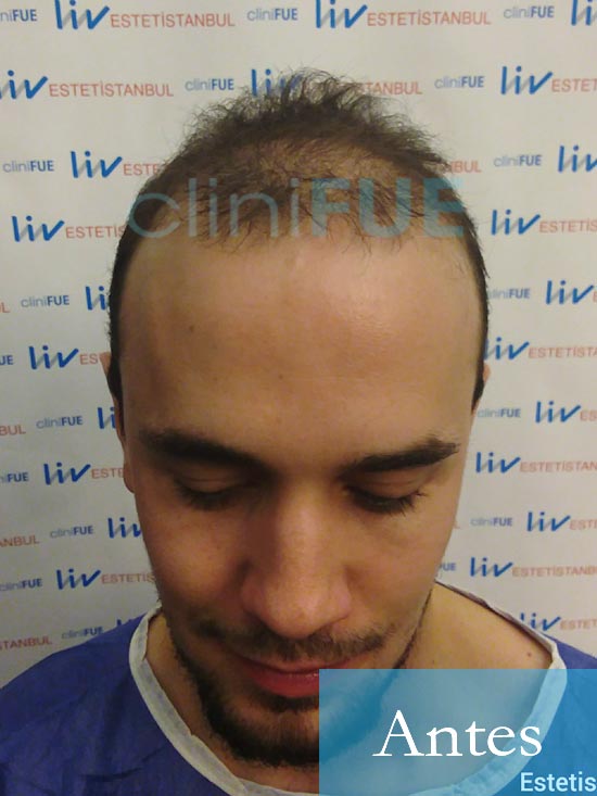 Martin 28 años Murcia trasplante capilar turquia Antes 