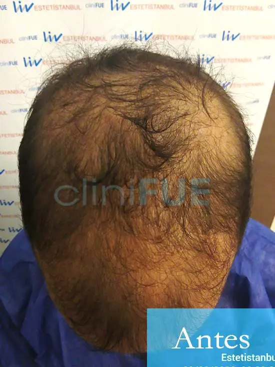 Martin 28 años Murcia trasplante capilar turquia Antes 2