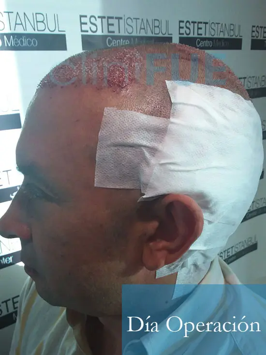 Miguel Angel 47 Valladolid injerto capilar turquia dia operacion