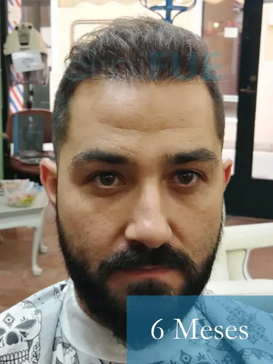 Oscar 33 anos trasplante turquia 6 meses 