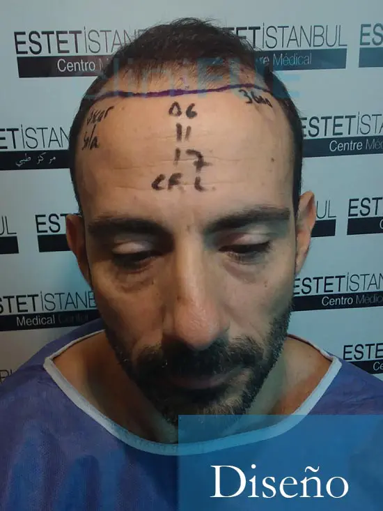 Oscar 38 Valencia antes de trasplante capilar cliniFUE dia operacion 