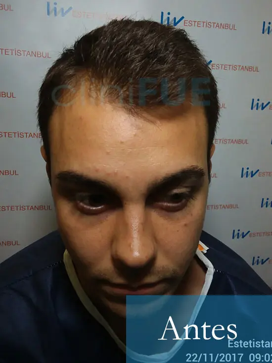 Rafael 25 Sevilla trasplante capilar turquia Antes dia operacion 1
