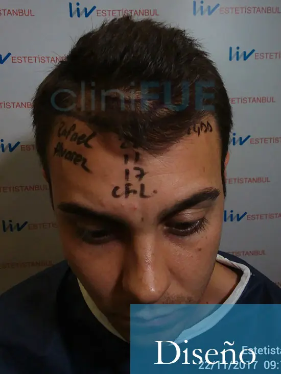 Rafael 25 Sevilla trasplante capilar turquia dia operacion diseno 1