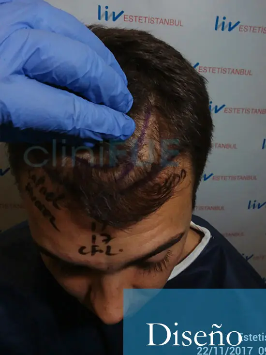 Rafael 25 Sevilla trasplante capilar turquia dia operacion diseno 2