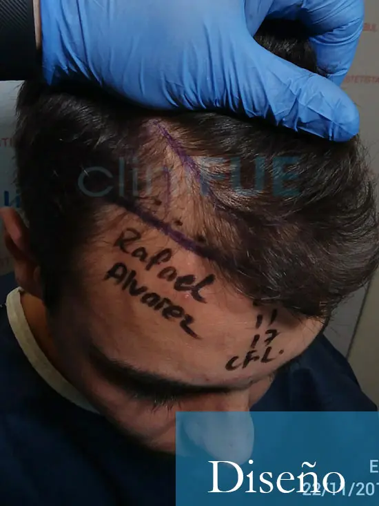 Rafael 25 Sevilla trasplante capilar turquia dia operacion diseno 3