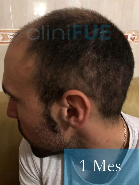 Rodrigo 26 años Almería trasplante capilar turquia 1 Mes