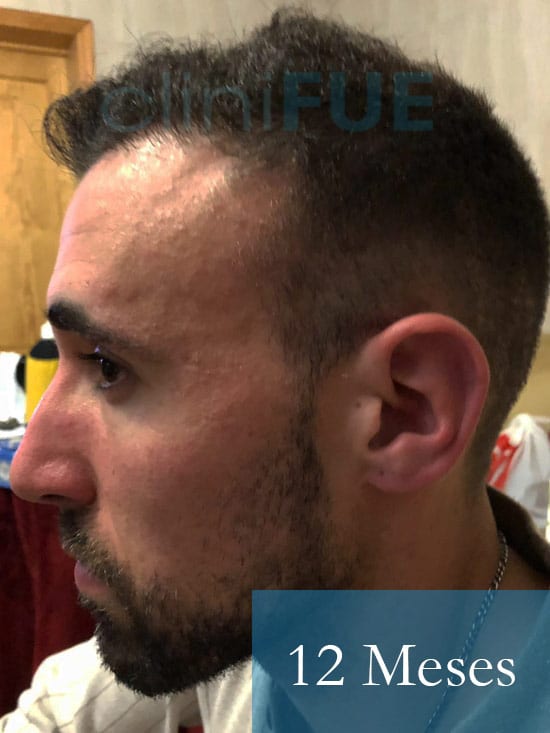 Rodrigo 26 años Almería trasplante capilar turquia 12 Meses 5