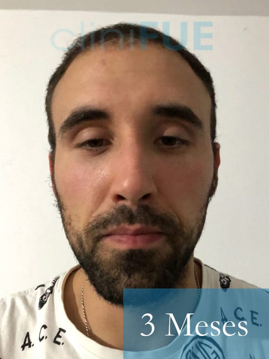 Rodrigo 26 años Almería trasplante capilar turquia 3 Meses 
