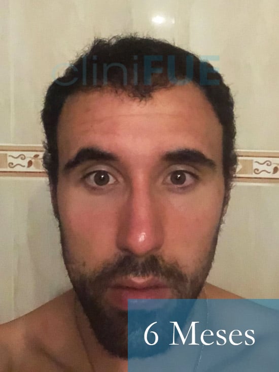 Rodrigo 26 años Almería trasplante capilar turquia 6 Meses 