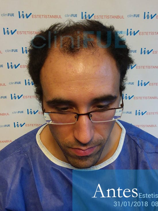 Rodrigo 26 años Almería trasplante capilar turquia Antes