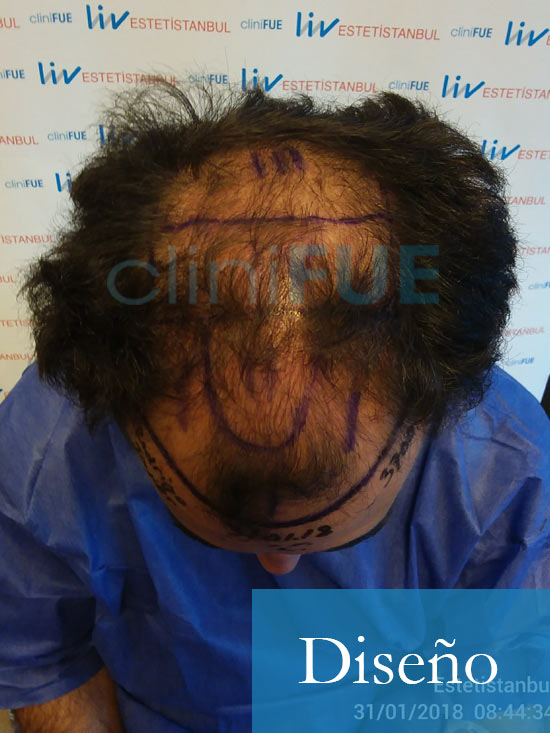 Rodrigo 26 años Almería trasplante capilar turquia dia operacion diseño 2