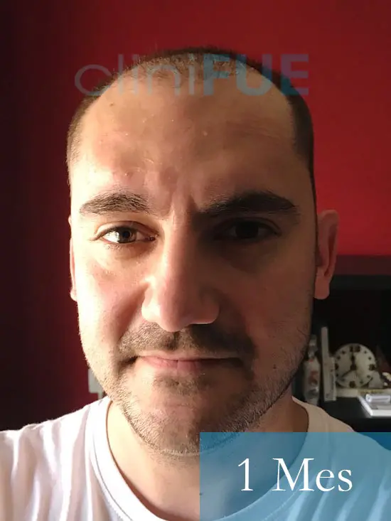 Sebastian 30 años Murcia trasplante capilar turquia 1 mes 