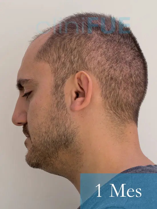 Sebastian 30 años Murcia trasplante capilar turquia 1 mes 4
