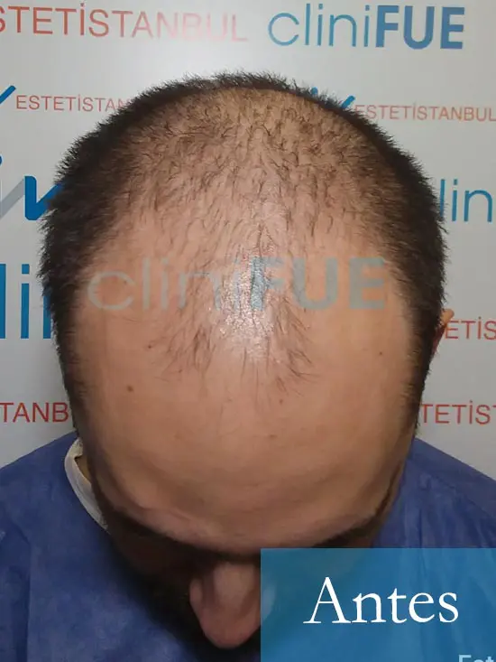 Sebastian 30 años Murcia trasplante capilar turquia Antes 2