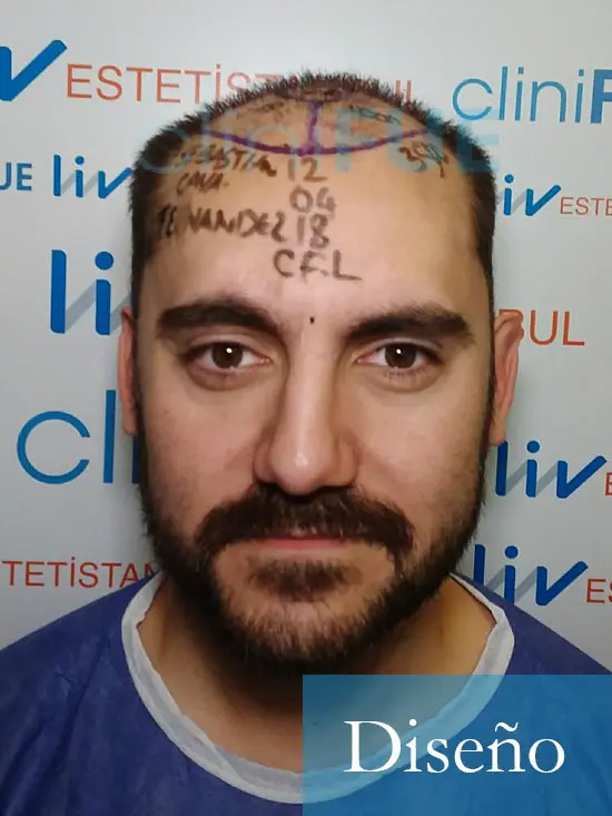 Sebastian 30 años Murcia trasplante capilar turquia diseño 