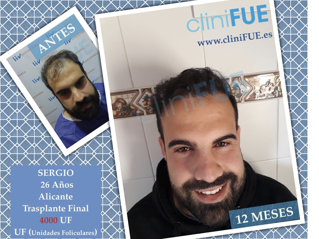 Sergio 26 años Alicante trasplante capilar turquia Antes 1