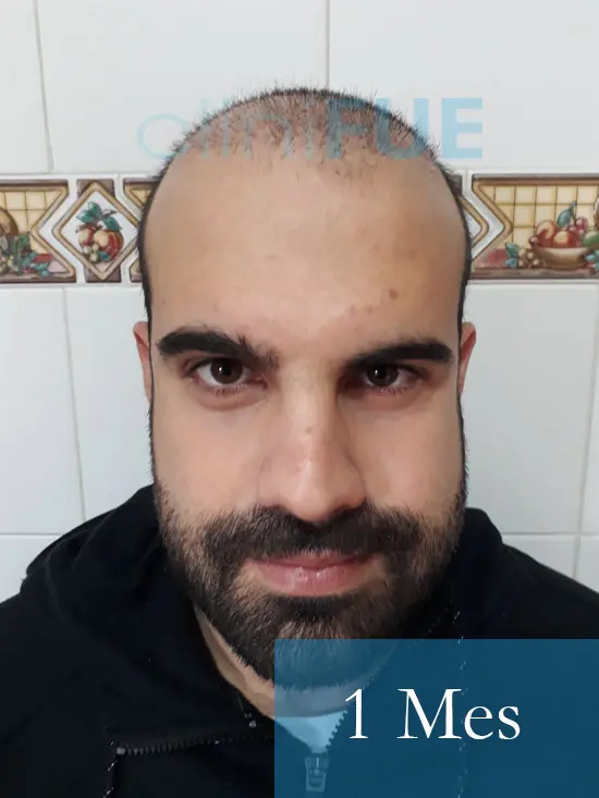 Sergio 26 años Alicante trasplante capilar turquia 1 Mes 
