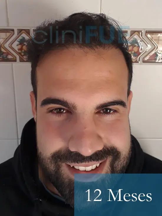 Sergio 26 años Alicante trasplante capilar turquia 12 Meses 