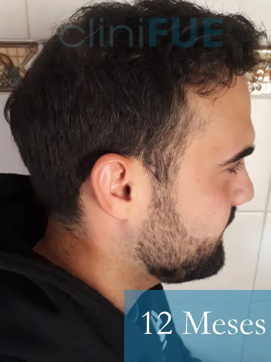 Sergio 26 años Alicante trasplante capilar turquia 12 Meses 3