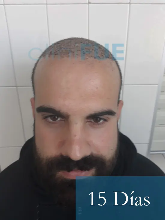Sergio 26 años Alicante trasplante capilar turquia 15 dias 1