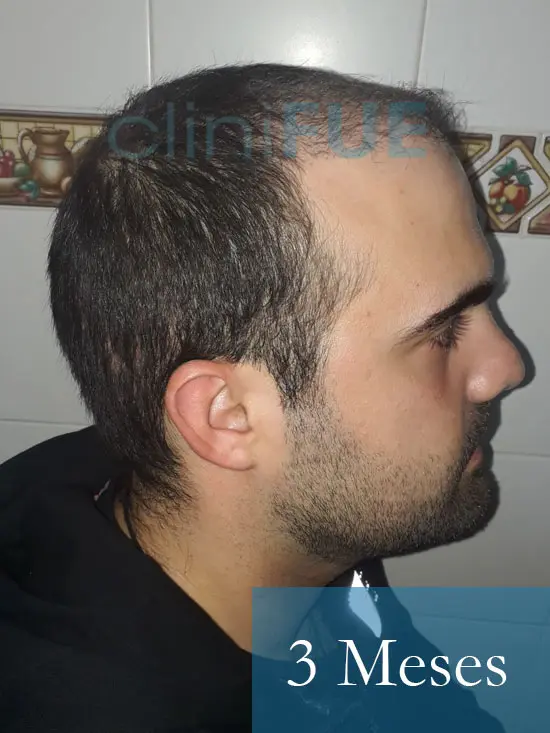 Sergio 26 años Alicante trasplante capilar turquia 3 Meses 3