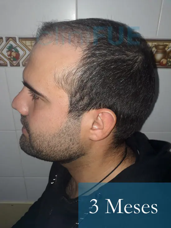 Sergio 26 años Alicante trasplante capilar turquia 3 Meses 4