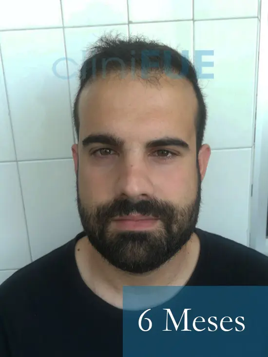 Sergio 26 años Alicante trasplante capilar turquia 6 Meses 1