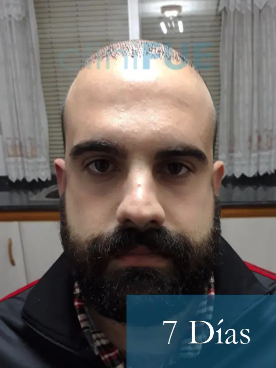 Sergio 26 años Alicante trasplante capilar turquia 7 dias 1