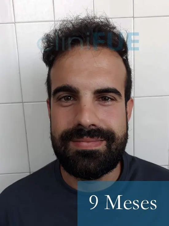 Sergio 26 años Alicante trasplante capilar turquia 9 Meses 1