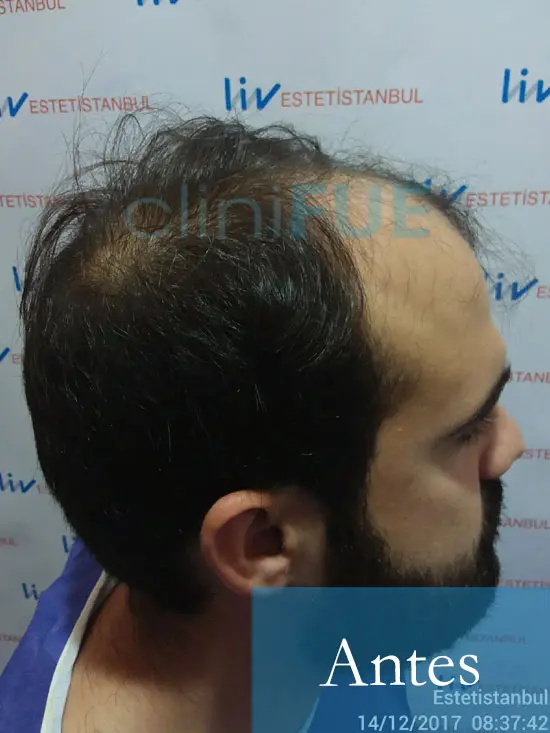 Sergio 26 años Alicante trasplante capilar turquia Antes 3