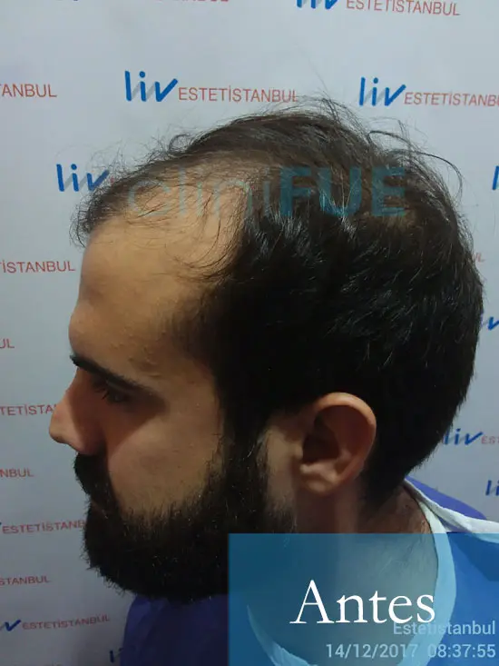Sergio 26 años Alicante trasplante capilar turquia Antes