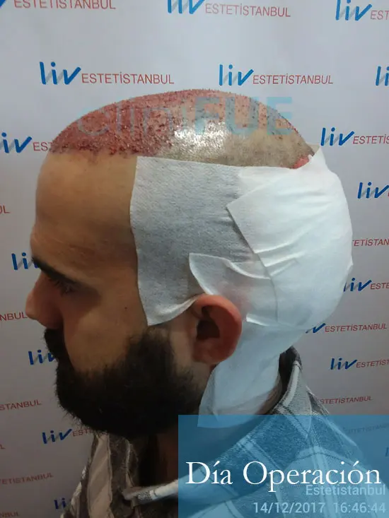 Sergio 26 años Alicante trasplante capilar turquia Dia Operacion 6