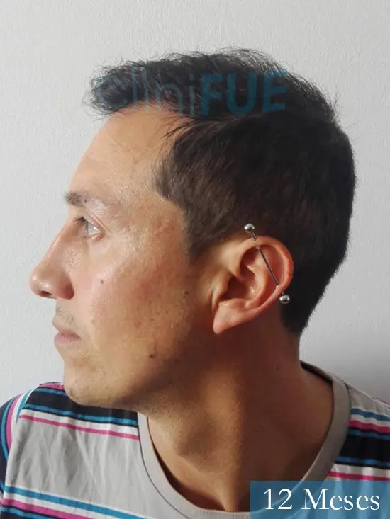 Andres 37 Barcelona injerto capilar turquia 12 meses 4