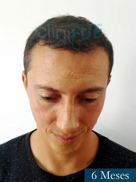 Andres 37 Barcelona injerto capilar turquia 6 meses 2