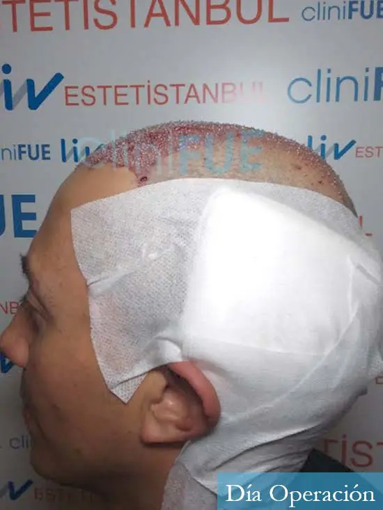 Andres 37 Barcelona injerto capilar turquia dia operacion 4