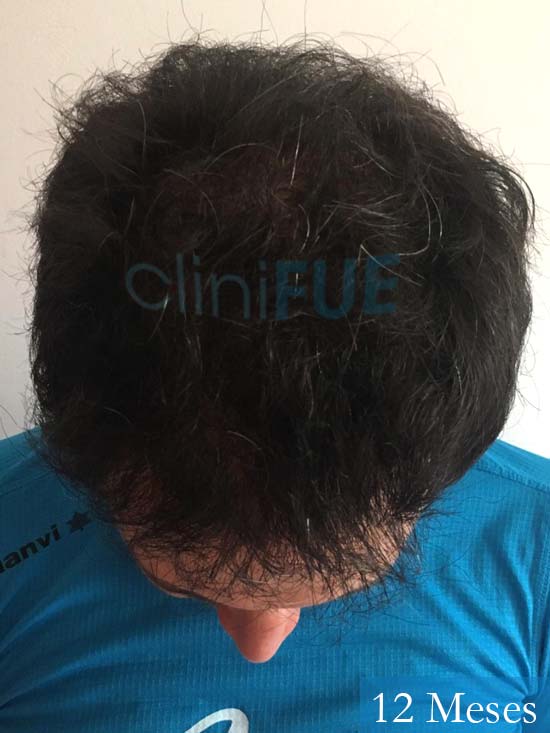 Carlos-34-Valencia-trasplante-capilar-turquia- 12 meses 2