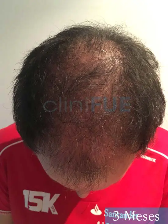 Carlos-34-Valencia-trasplante-capilar-turquia- 3 meses 2
