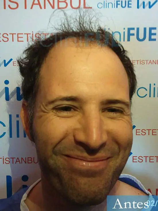 Carlos 34 Valencia trasplante capilar turquia antes dia operacion 