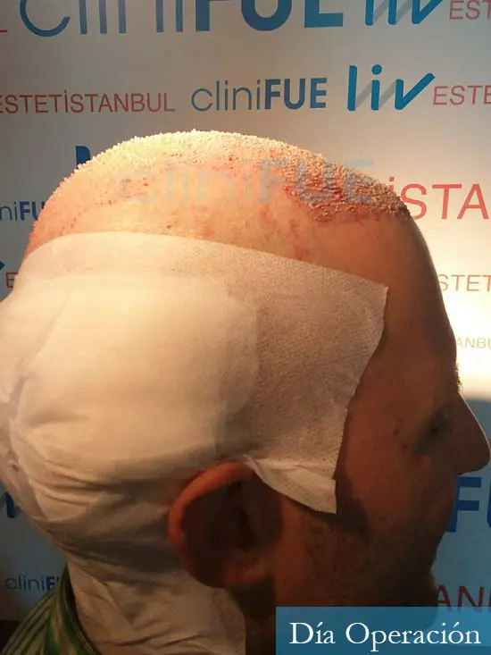 Carlos-34-Valencia-trasplante-capilar-turquia-dia-operacion 3