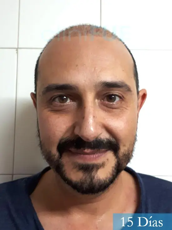 Cesar 40 anos Madrid injerto pelo turquia 15 dias 