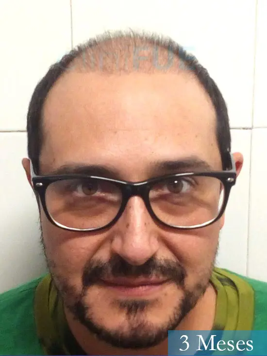 Cesar 40 anos Madrid injerto pelo turquia 3 meses 