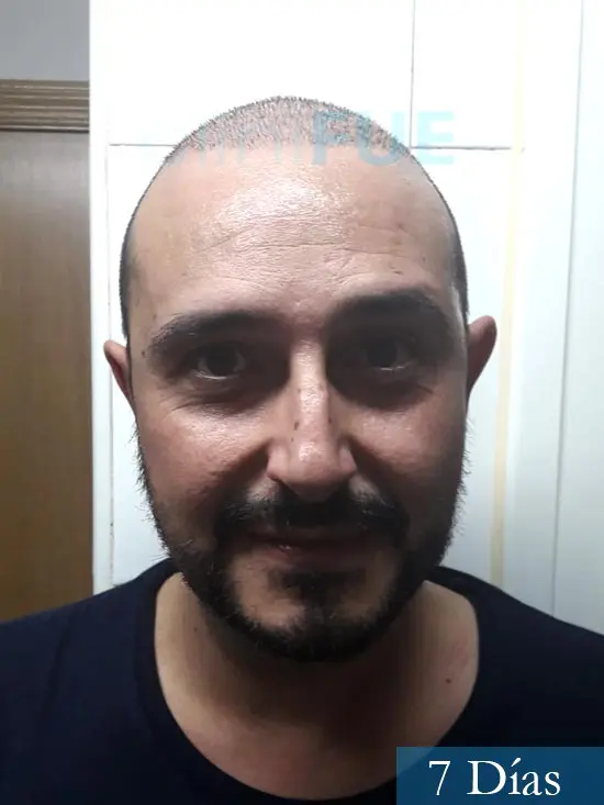 Cesar 40 anos Madrid injerto pelo turquia 7 dias 