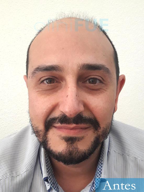 Cesar 40 anos Madrid injerto pelo turquia antes 