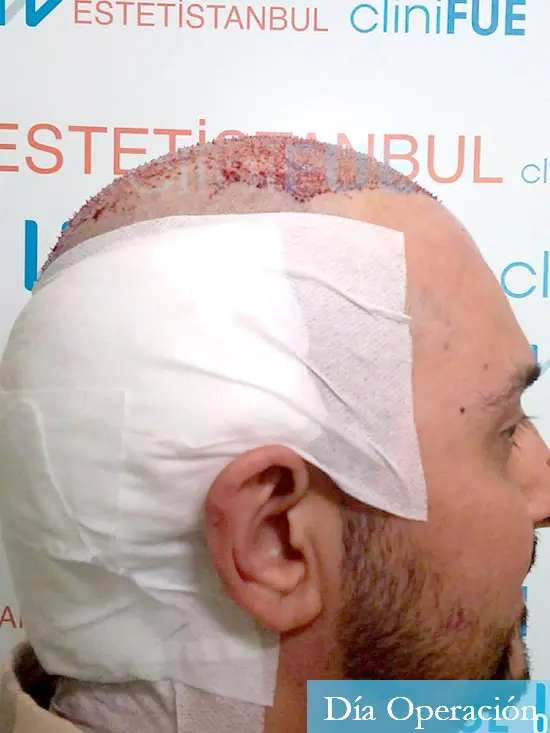 Cesar 40 anos Madrid injerto pelo turquia dia operacion 3