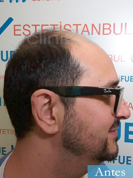 Cesar 40 anos Madrid injerto pelo turquia antes 3