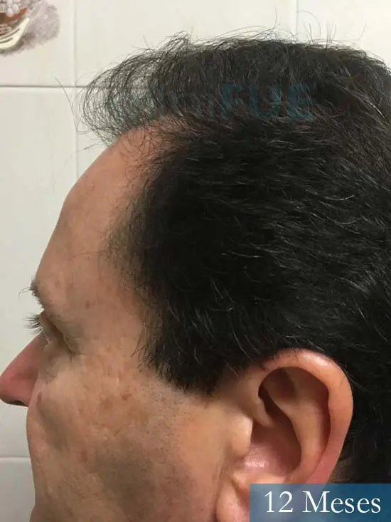 Jordi 56 Tarragona trasplante capilar turquia 12 meses 4